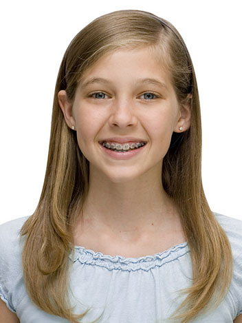 Braces FAQs | Indianapolis, IN | Premier Orthodontics