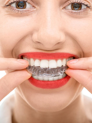 invisalign info