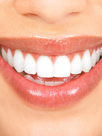 teeth whitening
