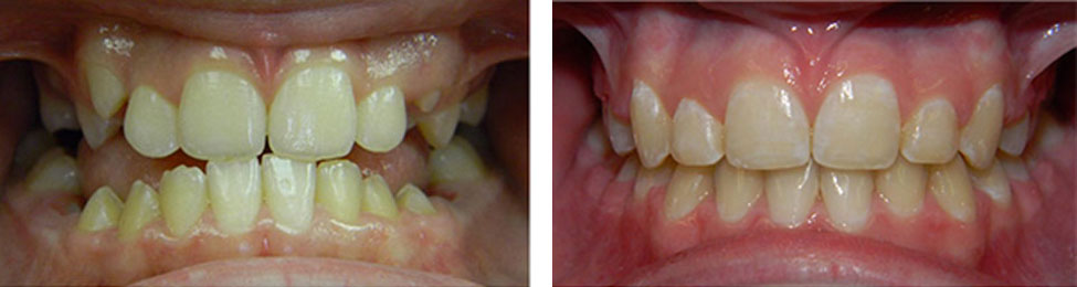 Crossbite before & after