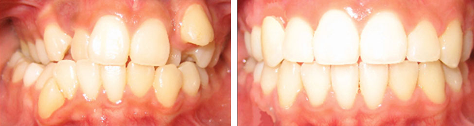 Crossbite before & after