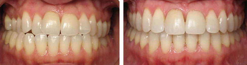 Crossbite before & after