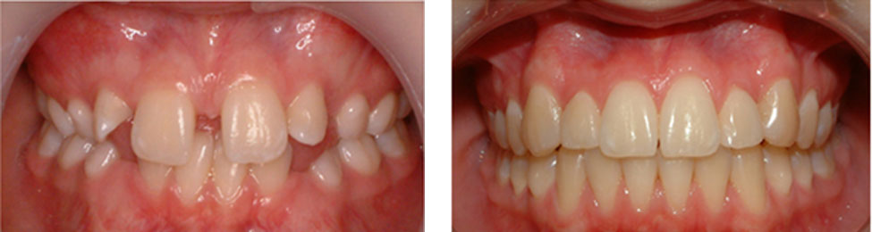 Missing Teeth before & after