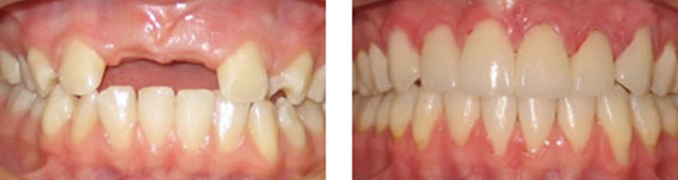 Missing Teeth before & after