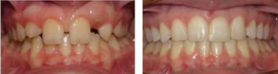 Missing Teeth before & after