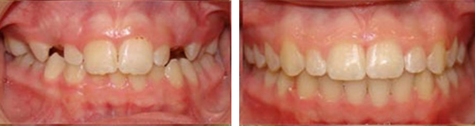 Missing Teeth before & after