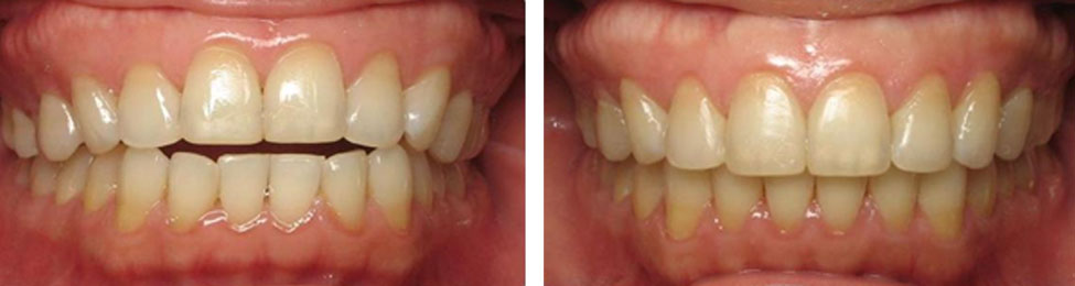 Open Bite before & after