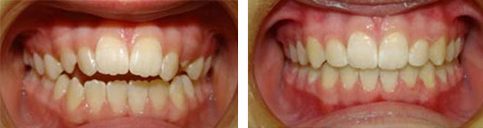 Open Bite before & after