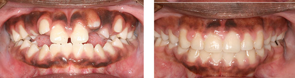 Open Bite before & after