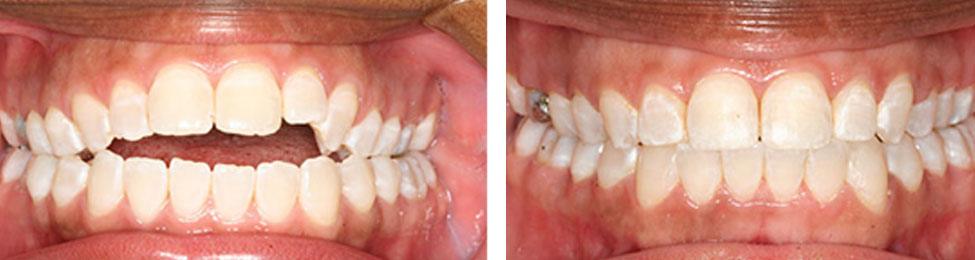 Open Bite before & after