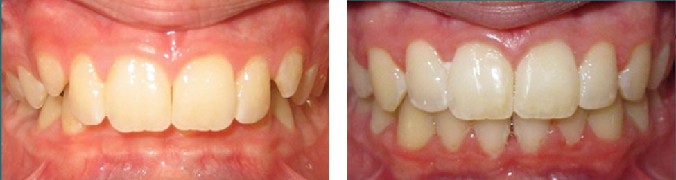 Overbite before & after