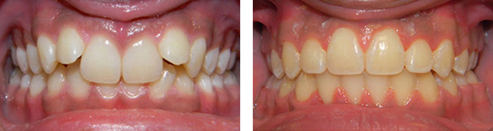 Overbite before & after