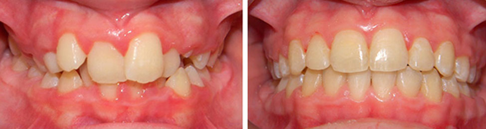 Overbite before & after