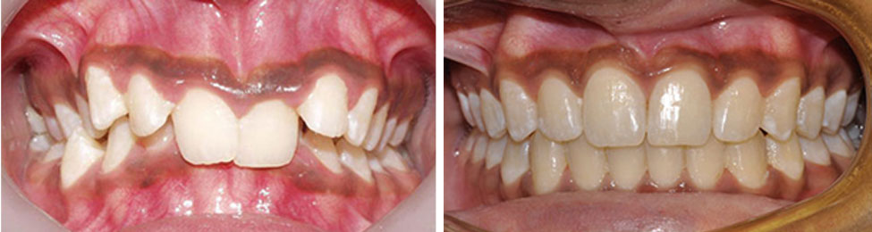 Overbite before & after