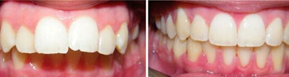 Overjet before & after