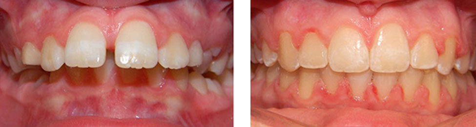 Overjet before & after