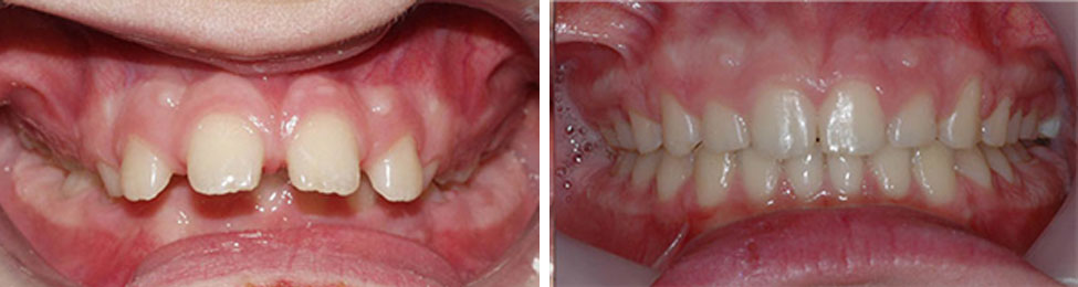 Overjet before & after