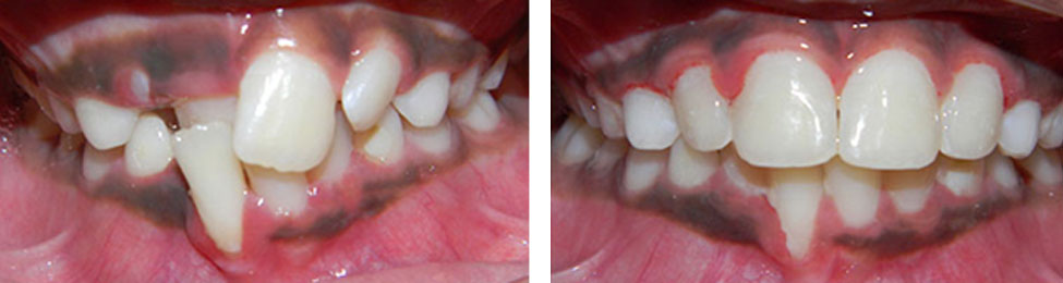 Phase One before & after