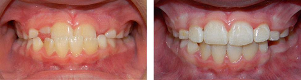 Phase One before & after