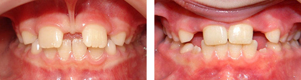 Phase One before & after