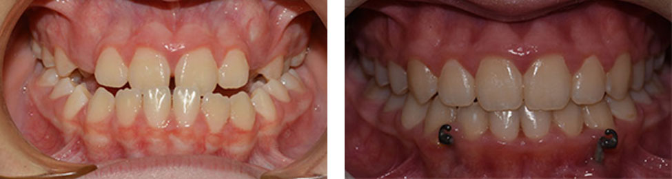 Underbite before & after