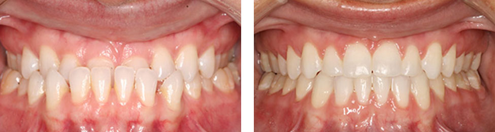 Underbite before & after