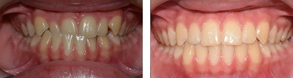 Underbite before & after